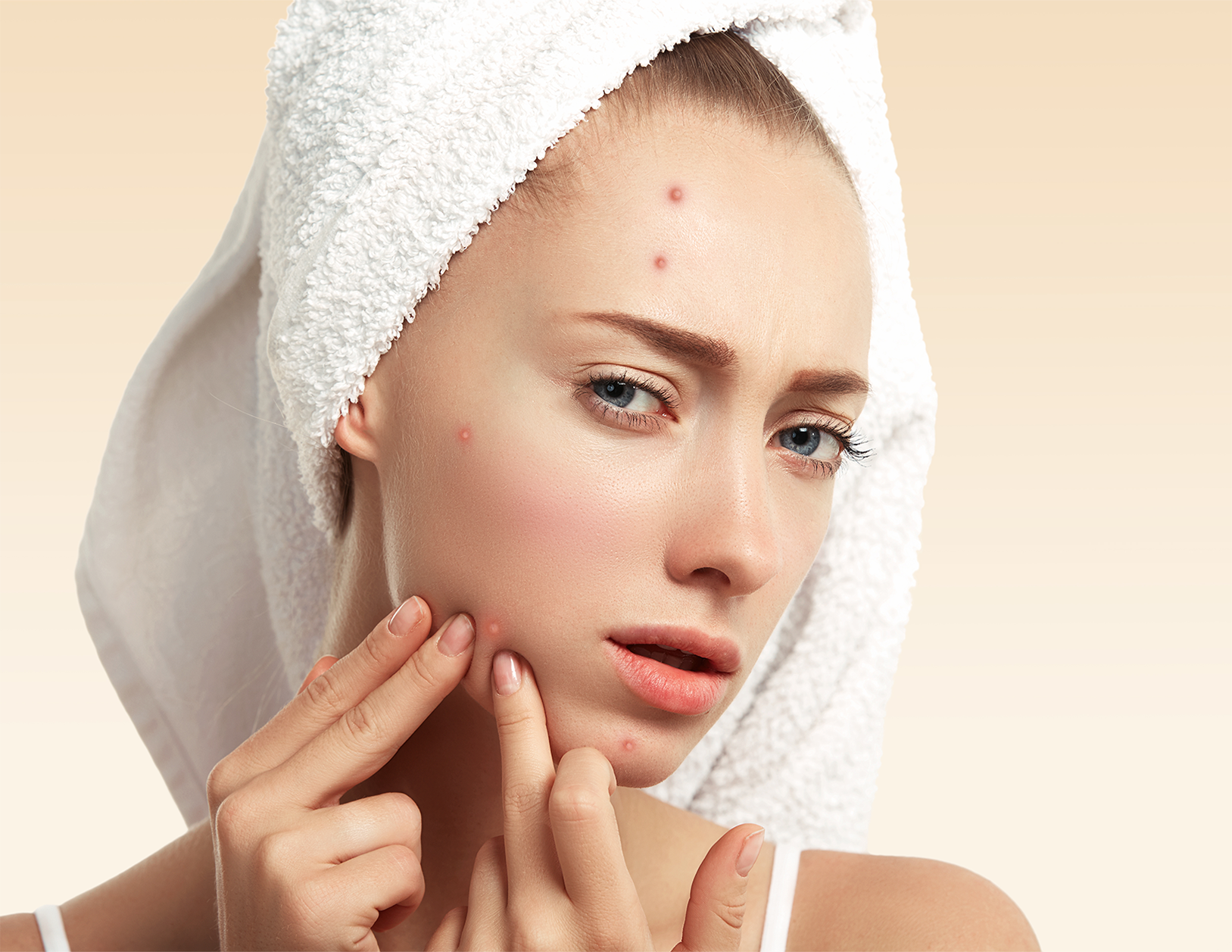The Ultimate Acne Solution Guide: Effective Treatments and Prevention Tips